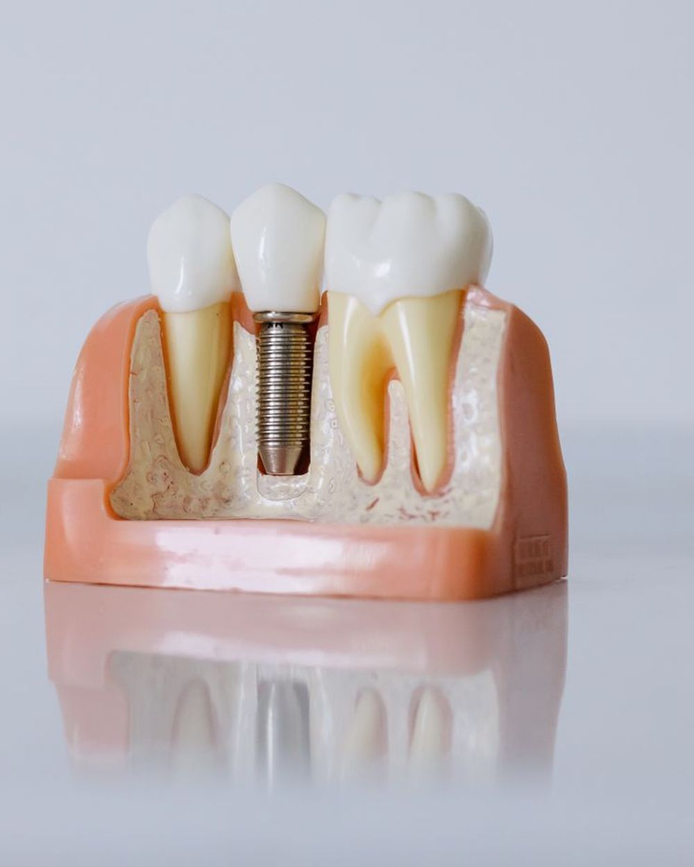 Impianti dentali